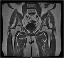 MRI of the Pelvis2 Pelvis MRI